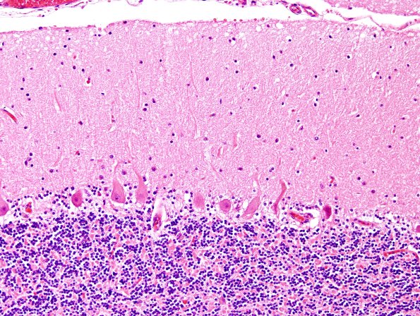 2H1 NCL (Case 2) L14 H&E 1.jpg