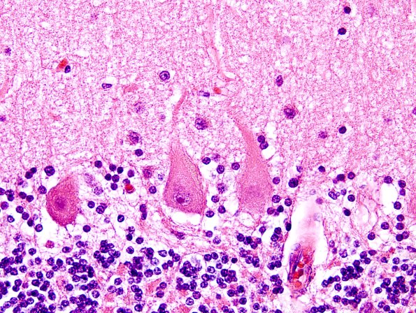 2H2 NCL (Case 2) L14 H&E 3.jpg