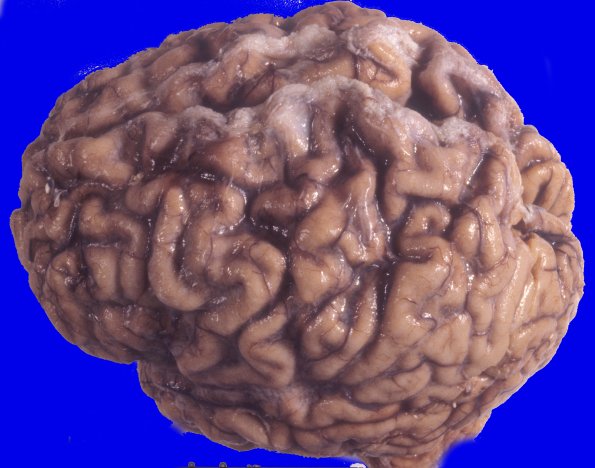 3A1 Neuronal Ceroid Lipofuscinosis (Case 3) A4