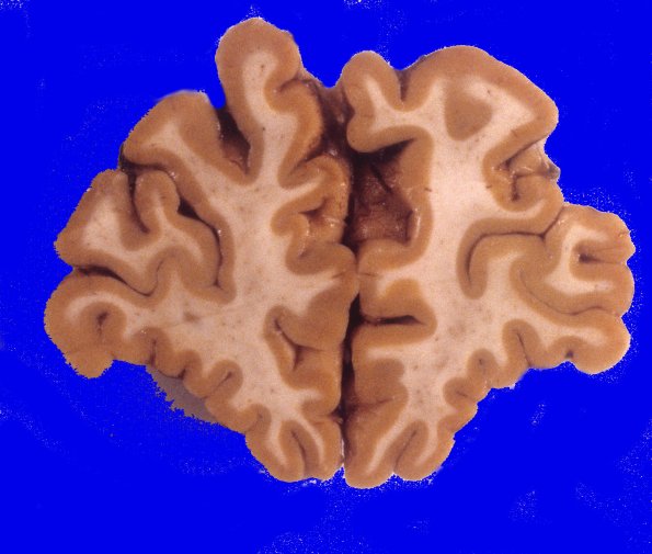 3A2 Neuronal Ceroid Lipofuscinosis (Case 3) A7