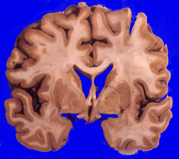 3A3 Neuronal Ceroid Lipofuscinosis (Case 3) A11
