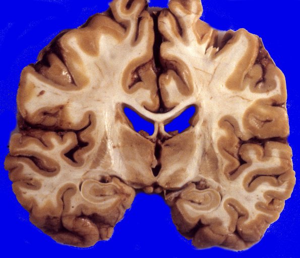3A4 Neuronal Ceroid Lipofuscinosis (Case 3) A1