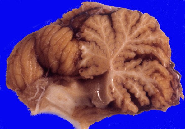 3A5 Neuronal Ceroid Lipofuscinosis (Case 3) A5