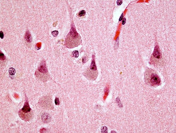 3B3 Neuronal Ceroid Lipofuscinosis (Case 3) cortex 1