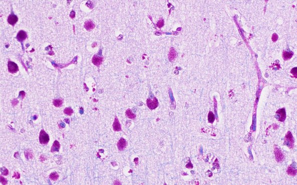 3C1 NCL PAS (Case 3) 40X