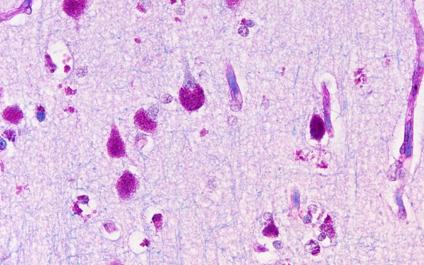3C2 PAS (NCL, Case 3) 60X