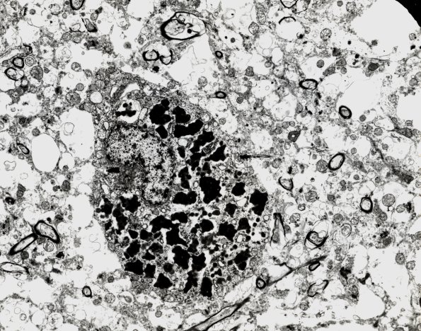 3E1 NCL (Case 3) cortex EM 1