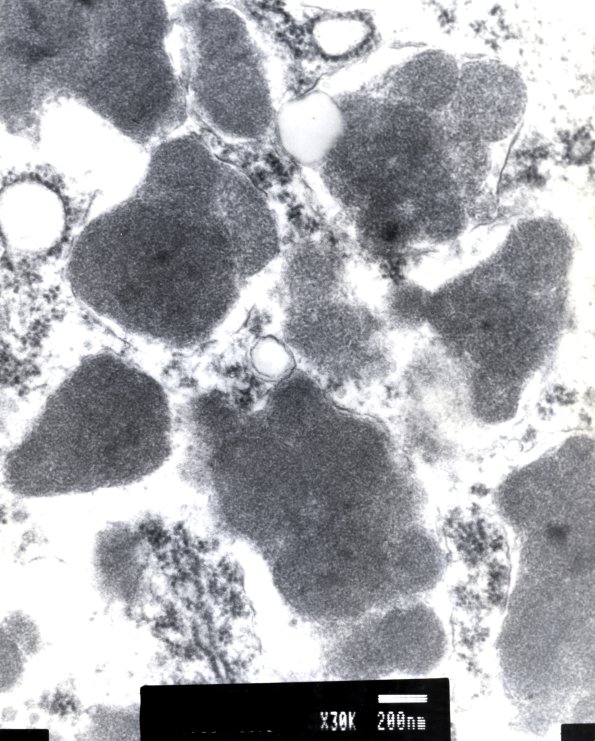 3E3 NCL (Case 3) cortex EM 5