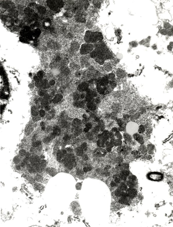 3E4 NCL (Case 3) cortex EM 4