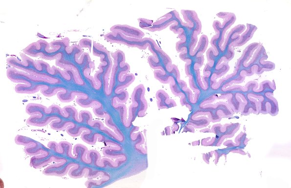 3F1 NCL (Case 3) LFB-PAS L2 WM 2