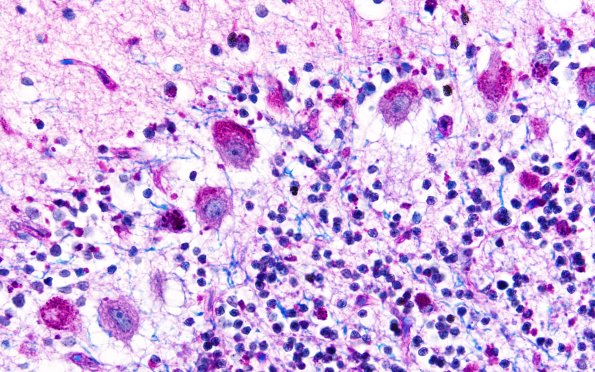 3F2 NCL (Case 3) LFB-PAS 60X 2