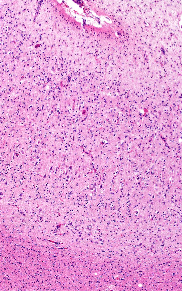 4B1 NCL (Case 4) H&E 10X1