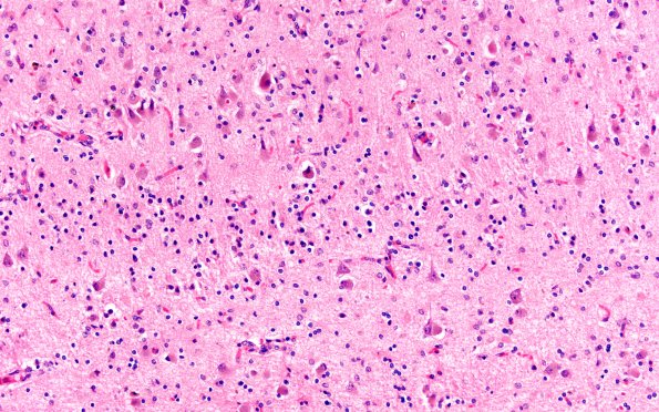 4B2 NCL (Case 4) H&E 20X 4