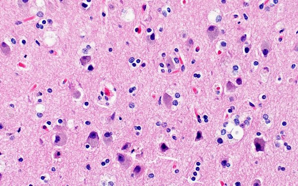 4B3 NCL (Case 4) H&E 40X4