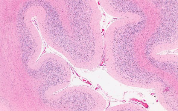 4C1 NCL (Case 4) Cbell 4X