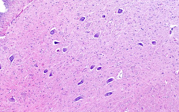 4D1 NCL (Case 4) H&E spinal cord 10X