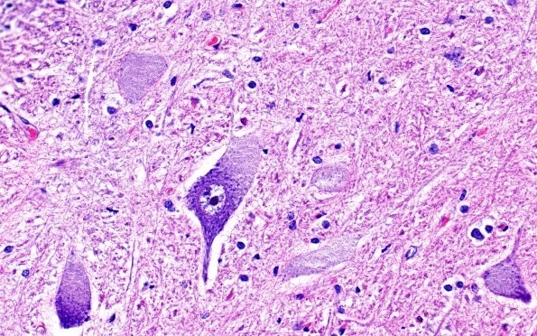 4D3 NCL (Case 4) H&E spinal cord 40X