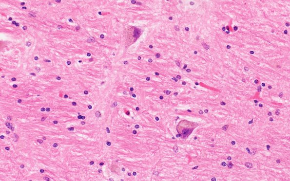 4E NCL (Case 4) BG 40X