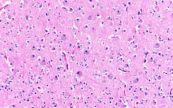 5B1 NCL (Case 5) L1B H&E 20X