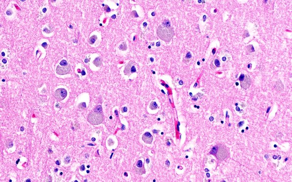 5B2 NCL (Case 5) L1B H&E 40X