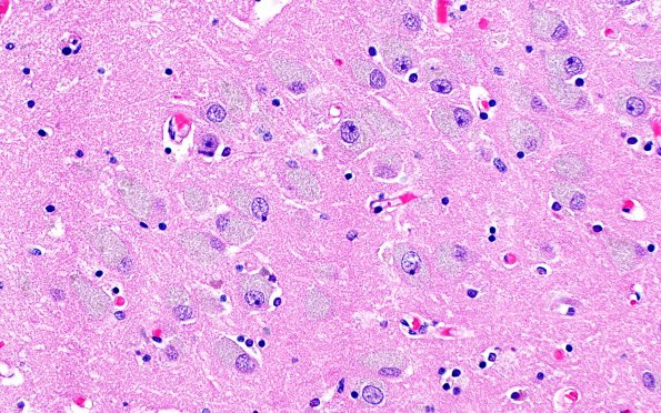 5B3 NCL (Case 5) H&E HC CA1 40X