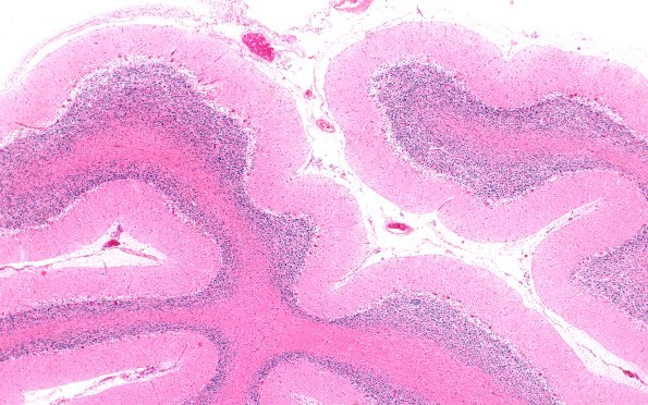 5D1 NCL (Case 5) Cbell 4X A