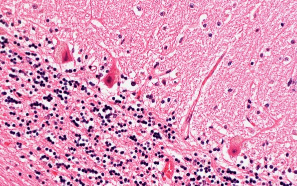 5D2 NCL (Case 5) Cbell 40X 2