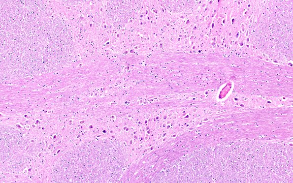 5E1 NCL (Case 5) Pons 10X A