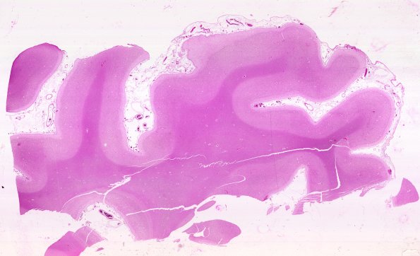 7B1 NCL (Case 7) Occip H&E WM