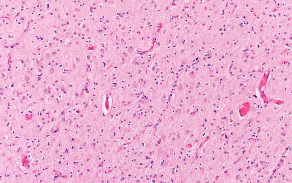 7B2 NCL (Case 7) Occip H&E 20X