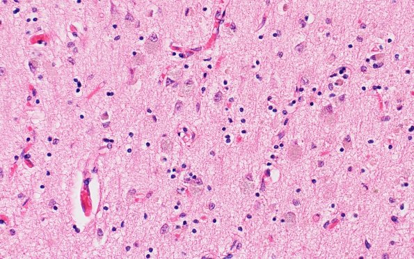 7B3 NCL (Case 7) Occip H&E 40X