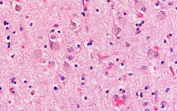 7B4 NCL (Case 7) Occip H&E 60X