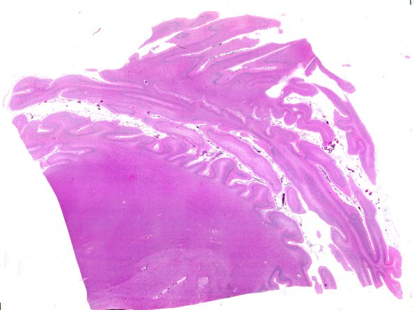 7C1 NCL (Case 7) Cbell & dentate H&E WM