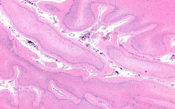 7C2 NCL (Case 7) Cbell & dentate H&E 2X
