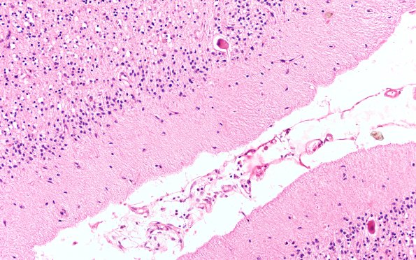 7C3 NCL (Case 7) Cbell & dentate H&E 20X 2