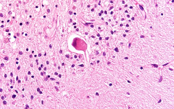 7C4 NCL (Case 7) Cbell & dentate H&E 60X 2