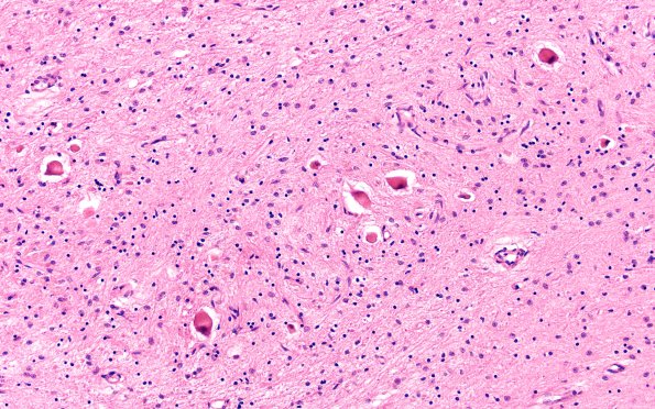 7C5 NCL (Case 7) Cbell dentate 20X H&E