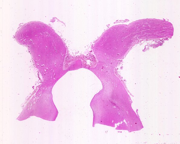 7D1 NCL (Case 7) Optic chiasm WM