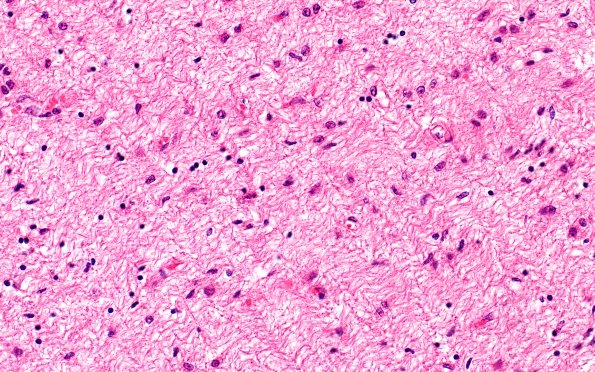 7D2 NCL (Case 7) Optic chiasm 40X 1