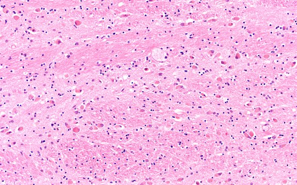 7E1 NCL (Case 7) Pons 20X H&E