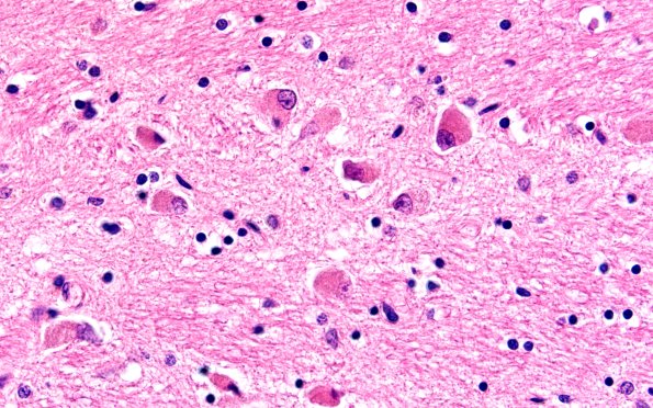 7E2 NCL (Case 7) Pons 60X H&E