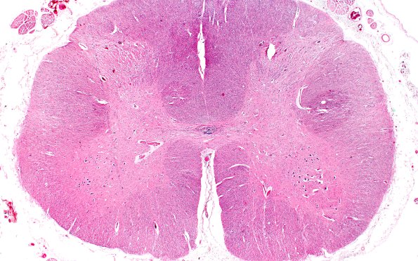 7F1 NCL (Case 7) LS Cord ant horn 2X 1A