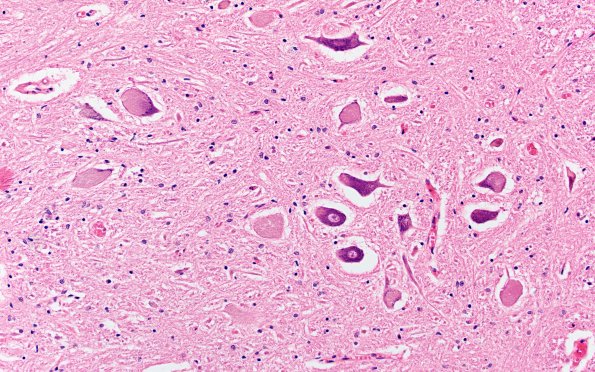 7F2 NCL (Case 7) LS COrd ant horn 20X 1