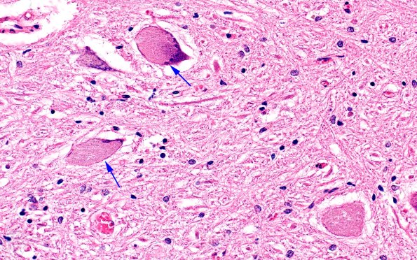 7F3 NCL (Case 7) LS COrd ant horn 40X 1 copy