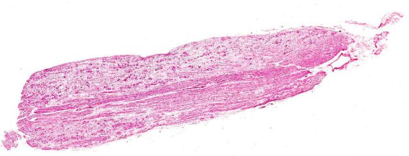 8A1 NCL (AANP 1974, Case 6) H&E X1.2