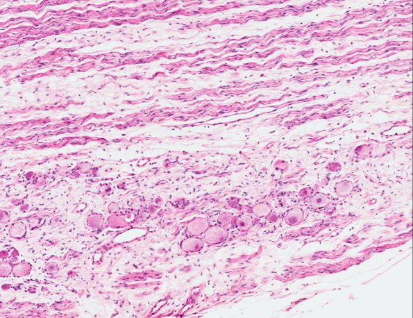8A2 NCL, Lumbar sympathetic ganglia (AANP 1974, Case 6) H&E X10