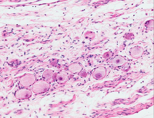 8A3 NCL (AANP 1974, Case 6) H&E X20 4