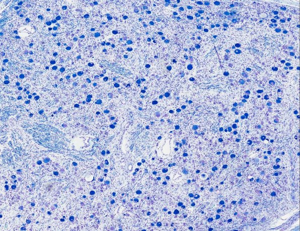 8B1 NCL (AANP 1974, Case 6) Kluver X4 1