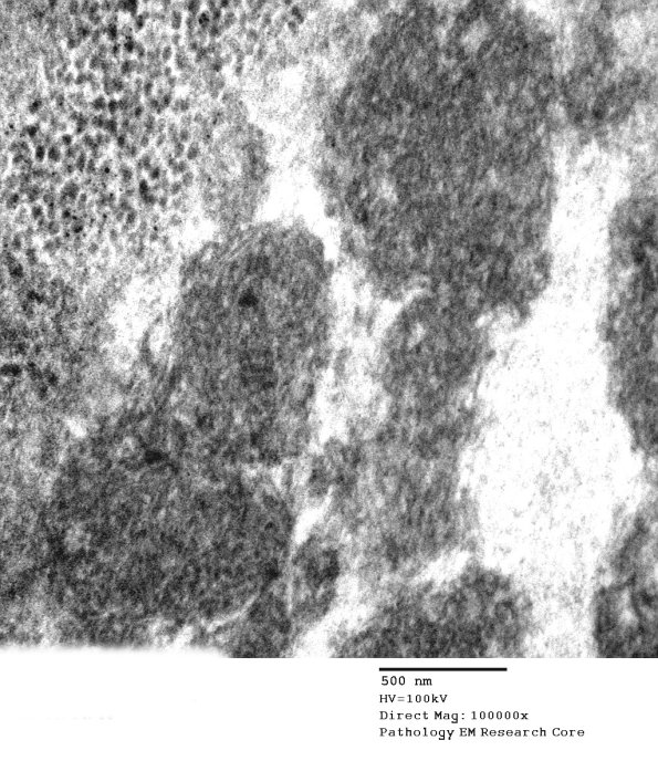 9A2B NCL (Case 9) Skin Bx EM 067A - Copy