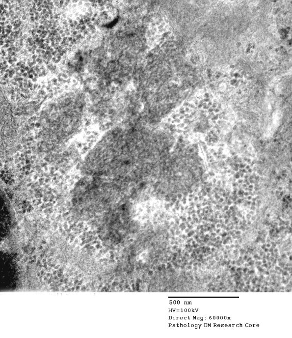 9A4 NCL (Case 9) Skin Bx EM 103A - Copy